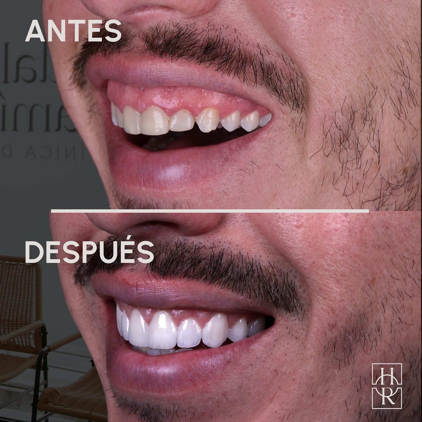 Diseño de sonrisa digital en Castelldefels – antes y después