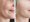 botox-tratamiento-antes-y-despues-castelldefels