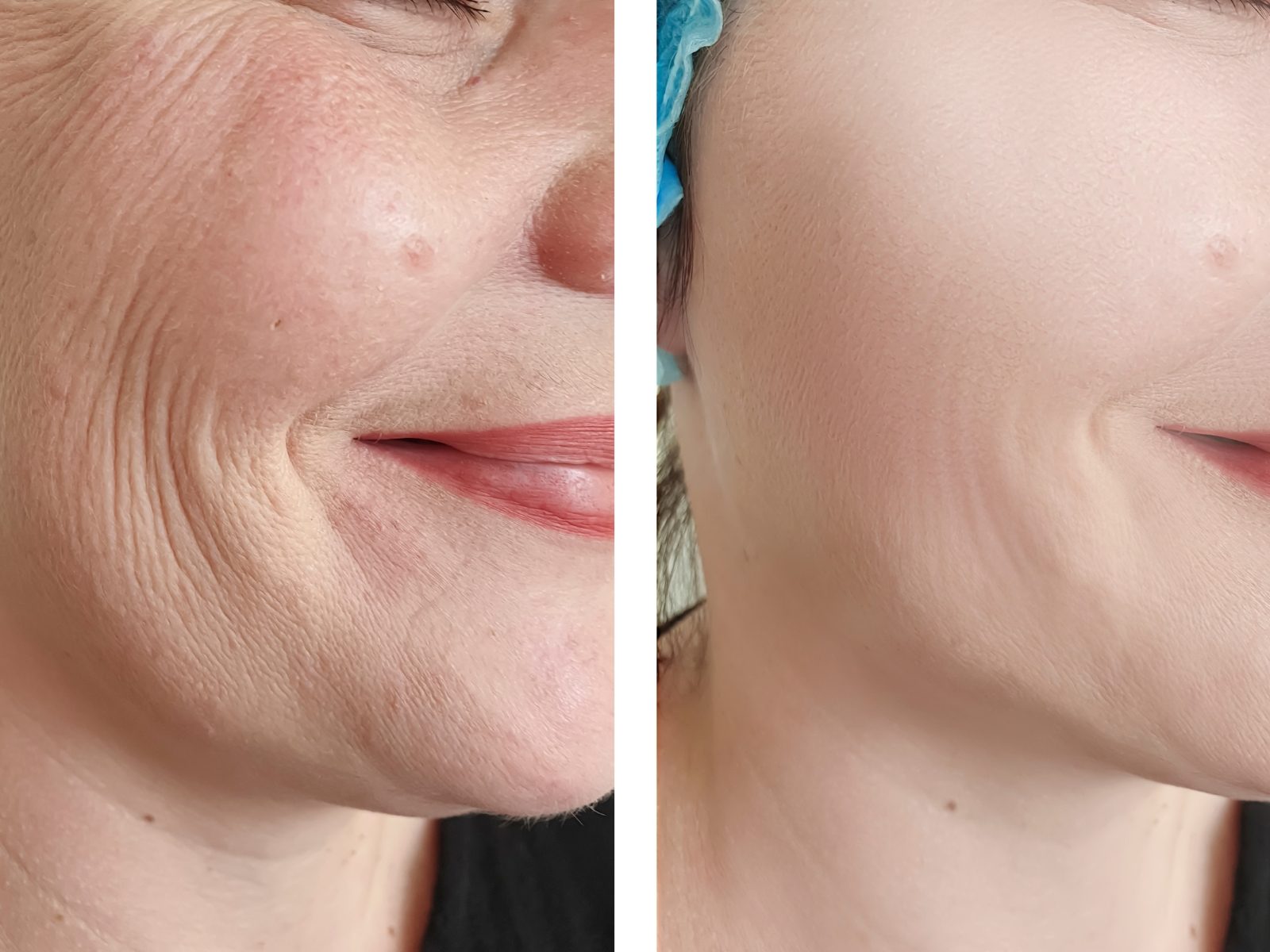 botox-tratamiento-antes-y-despues-castelldefels botox-tratamiento-antes-y-despues-castelldefels